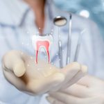 root canal treatment